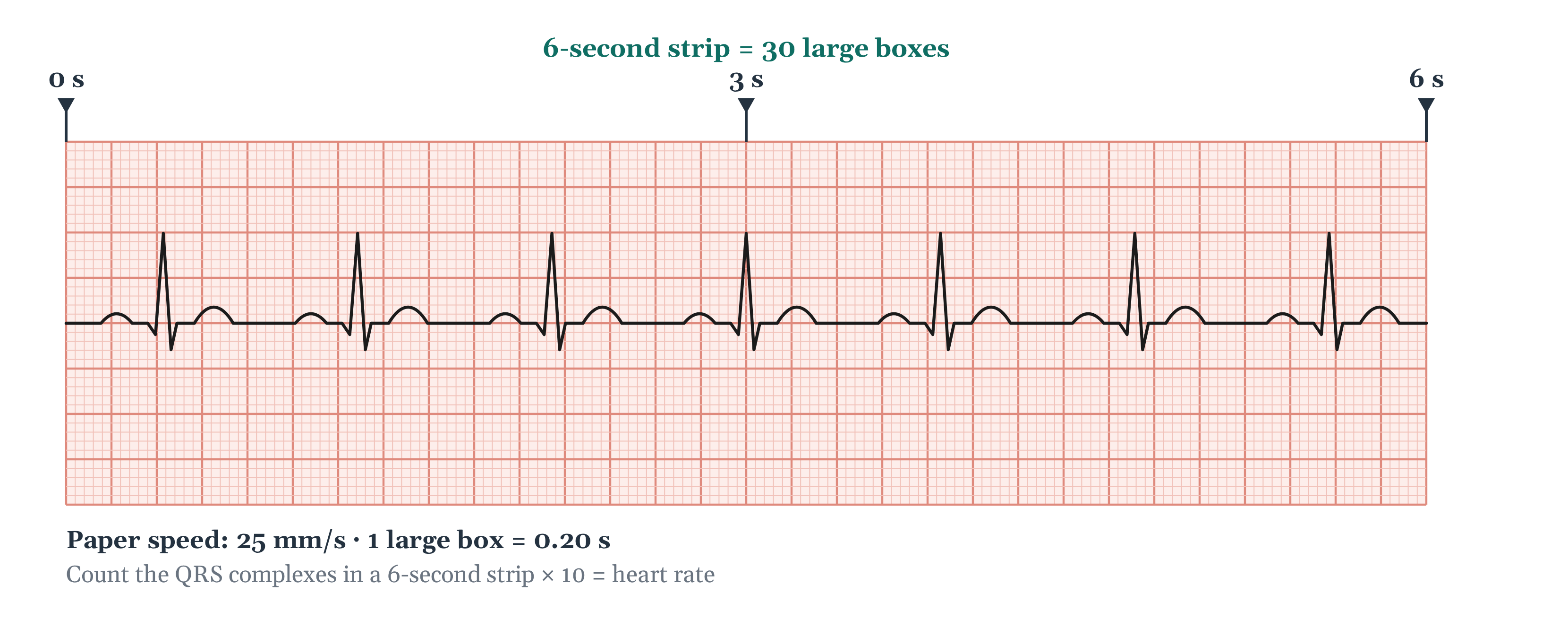 A 6-second ECG rhythm strip on standard grid paper, marked at 0, 3, and 6 seconds, showing seven evenly spaced narrow QRS complexes, each with a P wave before it.