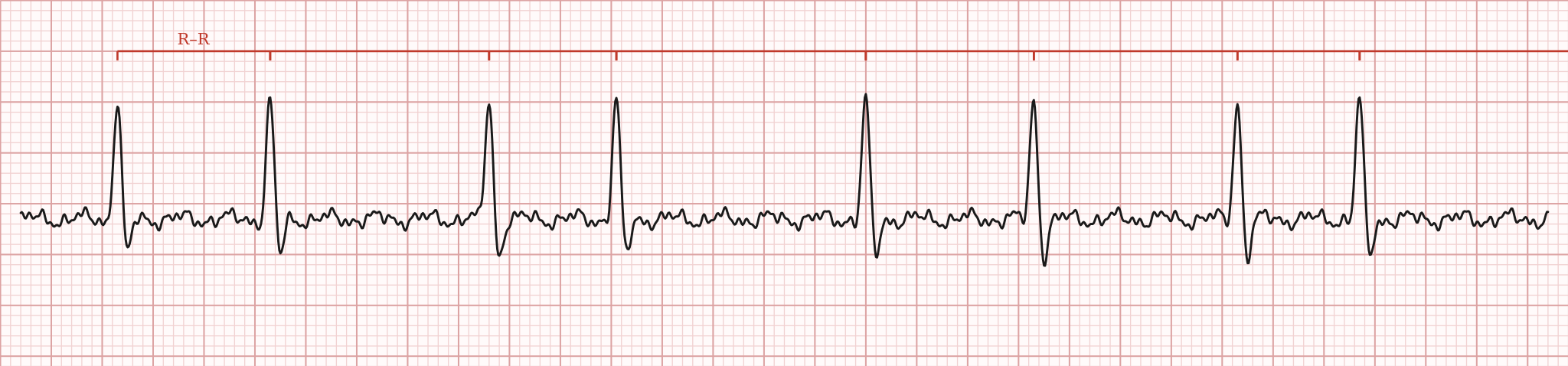 Rhythm strip with R-R markers showing uneven spacing between QRS complexes and a wavy baseline with no clear P waves.