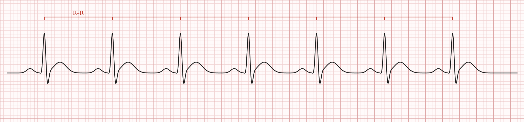 Rhythm strip with R-R markers showing equal spacing between every QRS complex.
